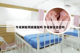 牛皮鲜能彻底康复吗 牛皮鲜会自愈吗