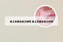 身上长癣会自己掉吗 身上长癣会自己好吗