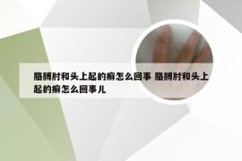 胳膊肘和头上起的癣怎么回事 胳膊肘和头上起的癣怎么回事儿