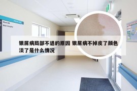 银屑病局部不退的原因 银屑病不掉皮了颜色淡了是什么情况