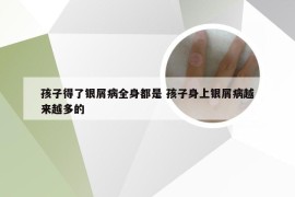 孩子得了银屑病全身都是 孩子身上银屑病越来越多的