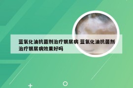 蓝氧化油抗菌剂治疗银屑病 蓝氧化油抗菌剂治疗银屑病效果好吗