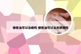 橄榄油可以治癣吗 橄榄油可以治皮肤病吗