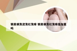 银屑病发烫发红发痒 银屑病发红发痒是加重吗