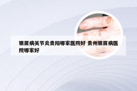 银屑病关节炎贵阳哪家医院好 贵州银屑病医院哪家好