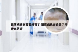 银屑病感觉又要感冒了 银屑病患者感冒了用什么药好