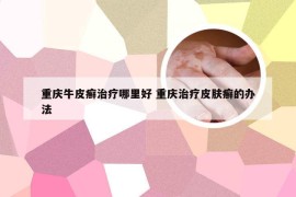 重庆牛皮癣治疗哪里好 重庆治疗皮肤癣的办法