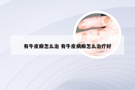 有牛皮癣怎么治 有牛皮病癣怎么治疗好