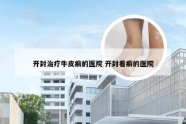 开封治疗牛皮癣的医院 开封看癣的医院