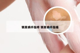 银屑病手指疼 银屑病手指痛