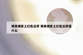 银屑病背上红色丘疹 银屑病背上红色丘疹是什么