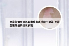 寻常型银屑病怎么治疗怎么才能不复发 寻常型银屑病的症状表现