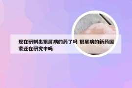 现在研制出银屑病的药了吗 银屑病的新药国家还在研究中吗