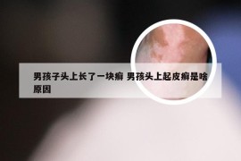 男孩子头上长了一块癣 男孩头上起皮癣是啥原因