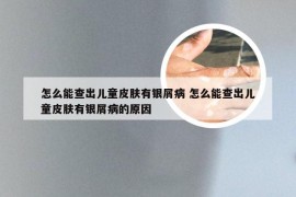 怎么能查出儿童皮肤有银屑病 怎么能查出儿童皮肤有银屑病的原因