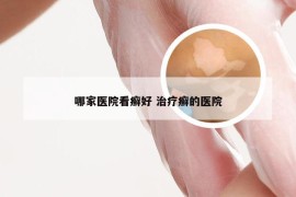 哪家医院看癣好 治疗癣的医院