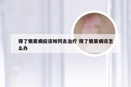 得了银屑病应该如何去治疗 得了银屑病该怎么办