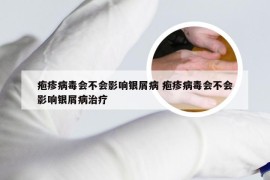 疱疹病毒会不会影响银屑病 疱疹病毒会不会影响银屑病治疗