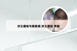 伏立康唑与银屑病 伏立康唑 甲癣