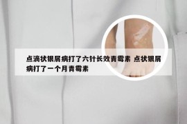 点滴状银屑病打了六针长效青霉素 点状银屑病打了一个月青霉素