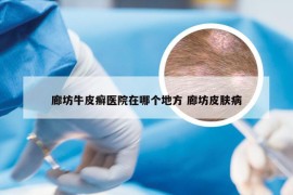 廊坊牛皮癣医院在哪个地方 廊坊皮肤病
