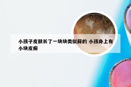 小孩子皮肤长了一块块类似藓的 小孩身上有小块皮癣