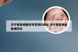 济宁银屑病医院专家预约地址 济宁银屑病皮肤病评价