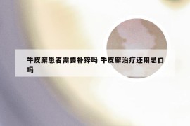 牛皮廨患者需要补锌吗 牛皮廨治疗还用忌口吗