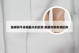 股癣和牛皮癣最大的区别 股藓和银屑病区别