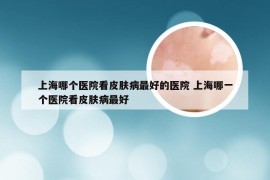 上海哪个医院看皮肤病最好的医院 上海哪一个医院看皮肤病最好