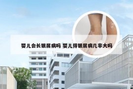 婴儿会长银屑病吗 婴儿得银屑病几率大吗