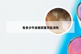 有多少牛皮癣到夏天能消失