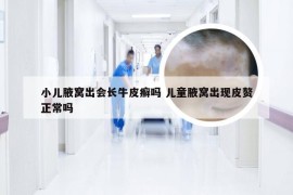 小儿腋窝出会长牛皮癣吗 儿童腋窝出现皮赘正常吗