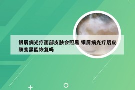 银屑病光疗面部皮肤会照黑 银屑病光疗后皮肤变黑能恢复吗