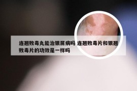 连翘败毒丸能治银屑病吗 连翘败毒片和银翘败毒片的功效是一样吗