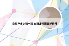 白斑净多少钱一瓶 白斑净抑菌膏好用吗