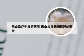 佛山治疗牛皮癣医院 佛山治皮肤病最好的医院
