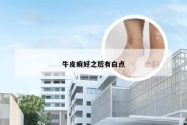 牛皮癣好之后有白点