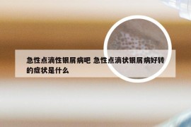 急性点滴性银屑病吧 急性点滴状银屑病好转的症状是什么