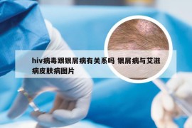 hiv病毒跟银屑病有关系吗 银屑病与艾滋病皮肤病图片