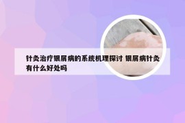 针灸治疗银屑病的系统机理探讨 银屑病针灸有什么好处吗