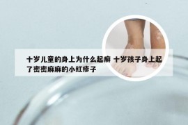 十岁儿童的身上为什么起癣 十岁孩子身上起了密密麻麻的小红疹子