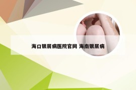 海口银屑病医院官网 海南银屑病