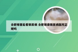 合肥哪里能看银屑病 合肥银康银屑病医院正规吗