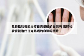氟轻松软膏能治疗日光暴晒的白斑吗 氟轻松软膏能治疗日光暴晒的白斑吗图片