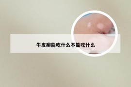 牛皮癣能吃什么不能吃什么