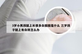 3岁小男孩腿上长很多白圈圈是什么 三岁孩子腿上有白斑怎么办