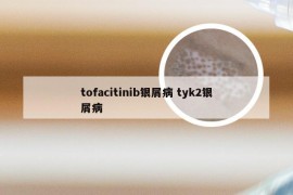 tofacitinib银屑病 tyk2银屑病