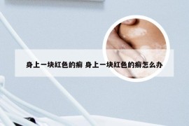 身上一块红色的癣 身上一块红色的癣怎么办