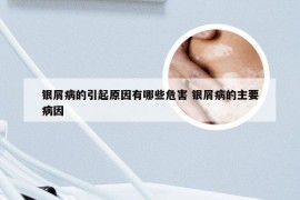 银屑病的引起原因有哪些危害 银屑病的主要病因